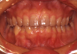「先天的変色歯」のケース
